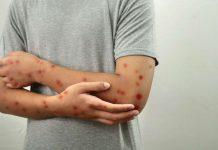 Atenção redobrada diante do aumento de casos de MPOX no Brasil